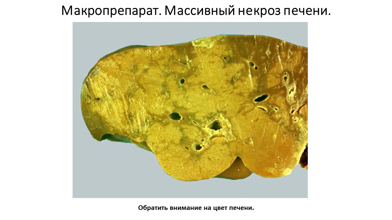 Макропрепарат. Массивный некроз печени.