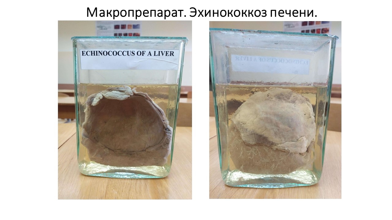 Макропрепарат. Эхинококкоз печени.