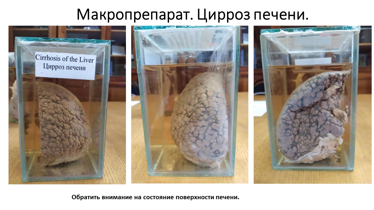 Макропрепарат. Цирроз печени.