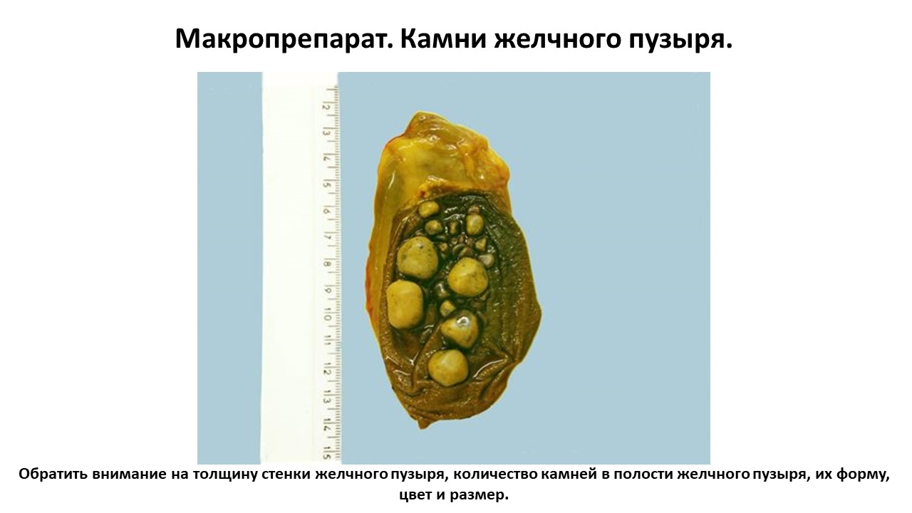 Макропрепарат. Камни желчного пузыря.