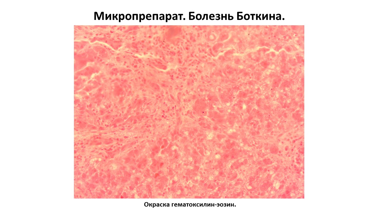 Микропрепарат. Болезнь Боткина.