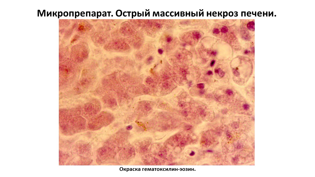 Микропрепарат. Острый массивный некроз печени.