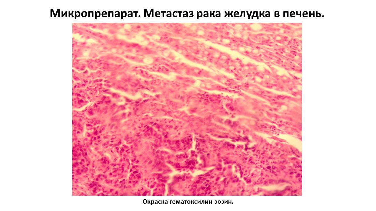 Микропрепарат. Метастаз рака желудка в печень.