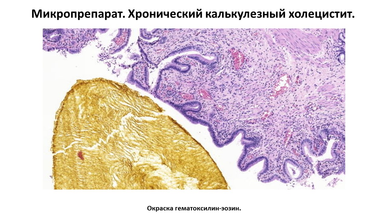 Микропрепарат. Хронический калькулезный холецистит.
